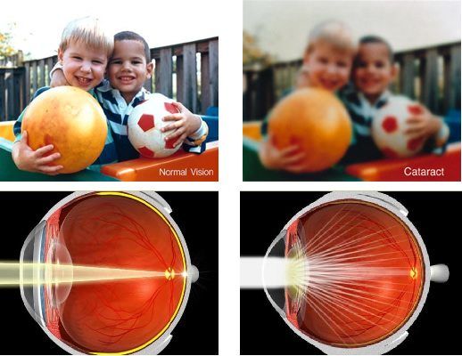 cataracts