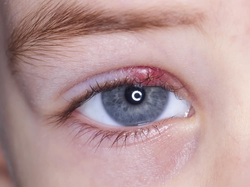 Close-up of child's eye with stye