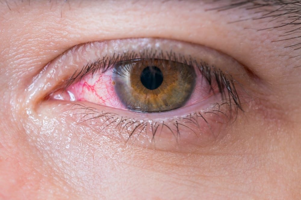 Close-up of red eye, conjunctivitis