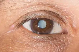 Close-up of eye with cataract
