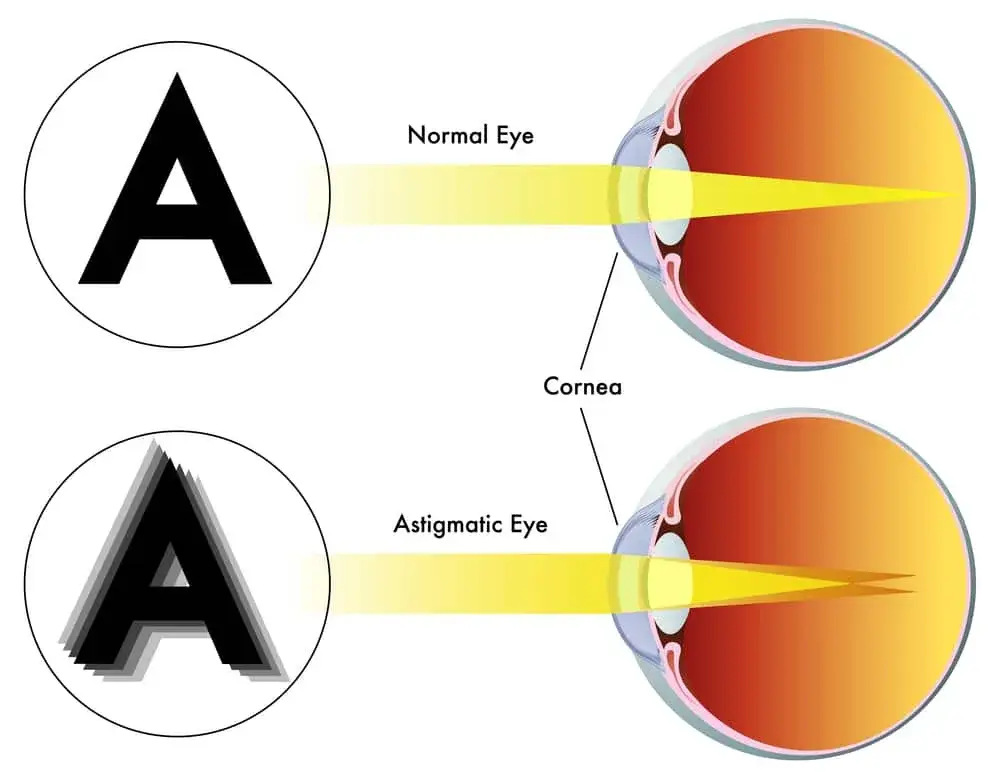 Graphic illustration depicting normal eye and eye with astigmatism