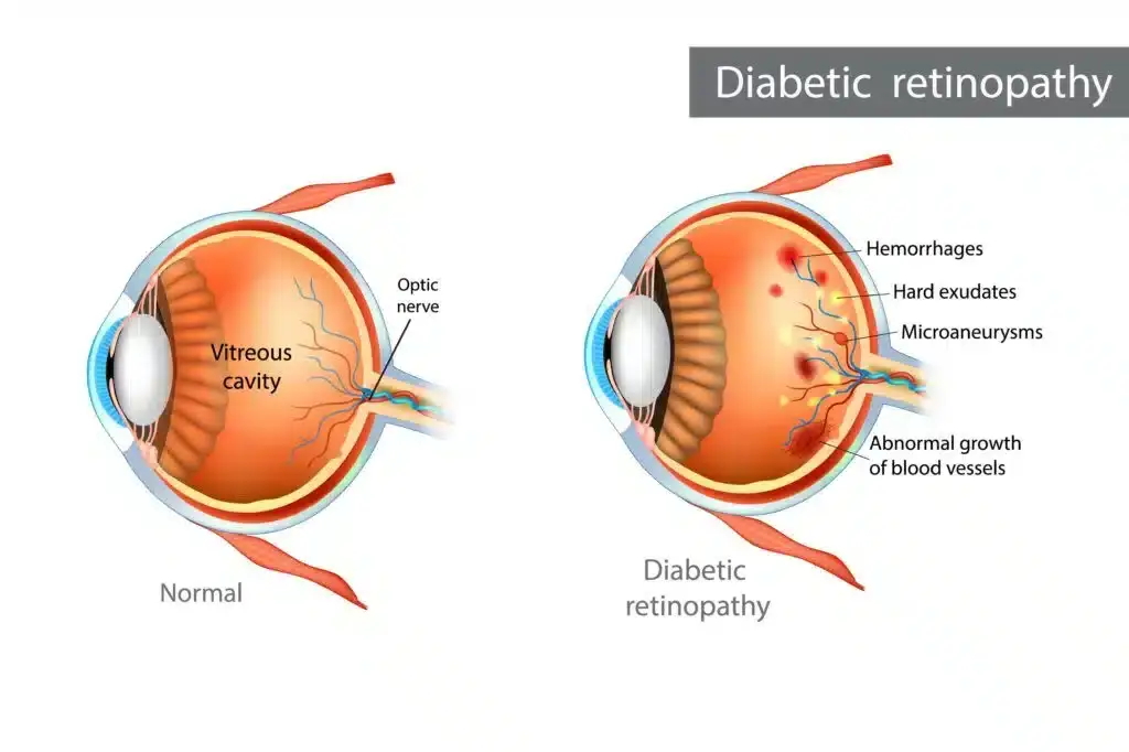 Diagram of eye with diabetic retinopathy and eye without