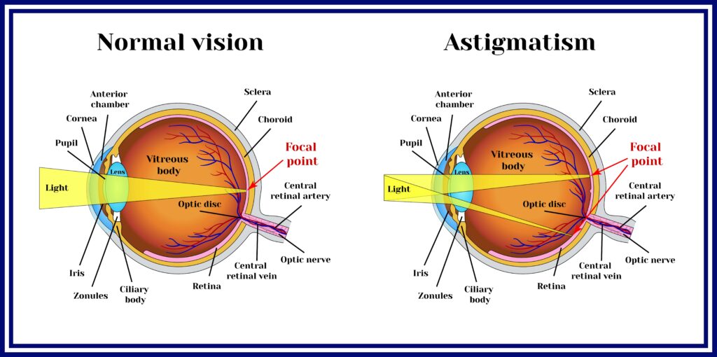 Normal vision and astigmatism diagrams