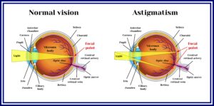 Normal vision and astigmatism diagrams