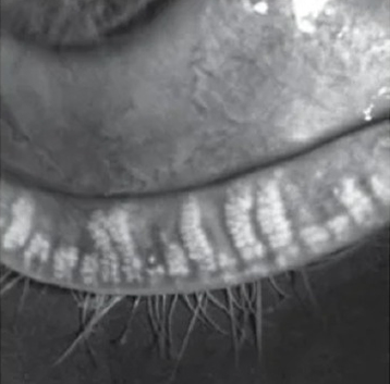 Moderate loss meibomian glands