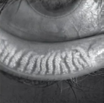 Normal meibomian glands