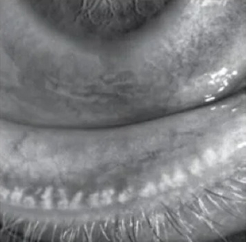 Severe Loss meibomian glands