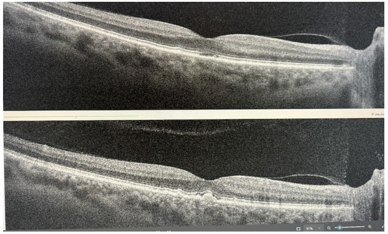Before and After Photobiomodulation Therapy